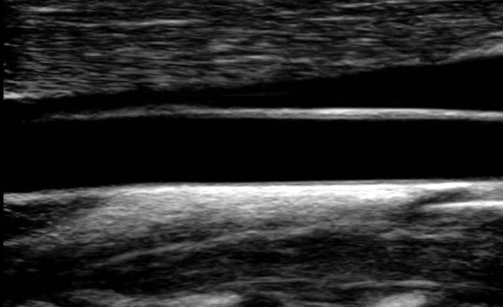 Ultrasound image of a carotid segmentation